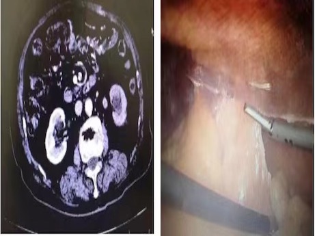 辽西首例“一体位腹腔镜下左肾盂癌根治术”成功