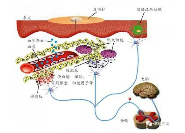 中医治疗| 小“图钉”大妙用——揿针疗法